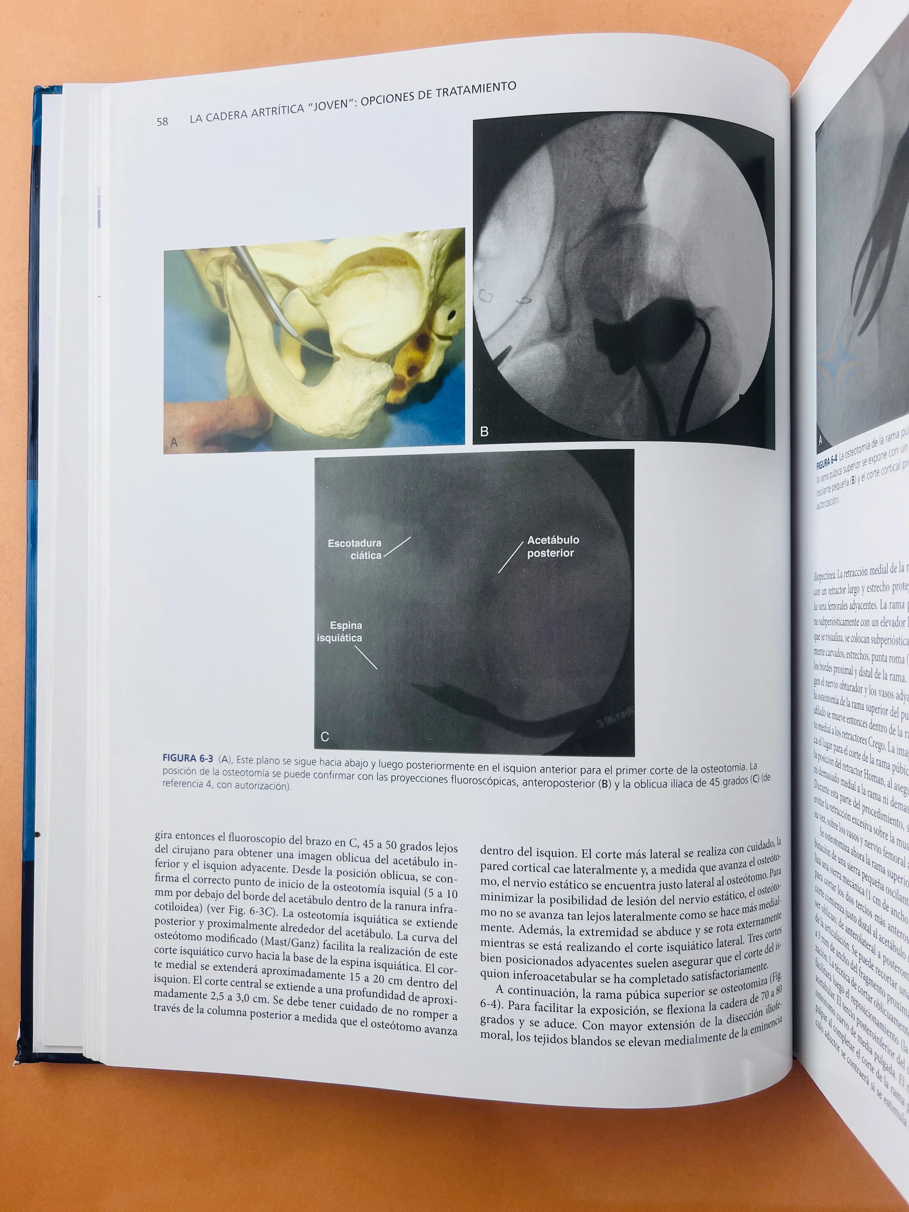 Artritis y Artroplastia Cadera - Image 3