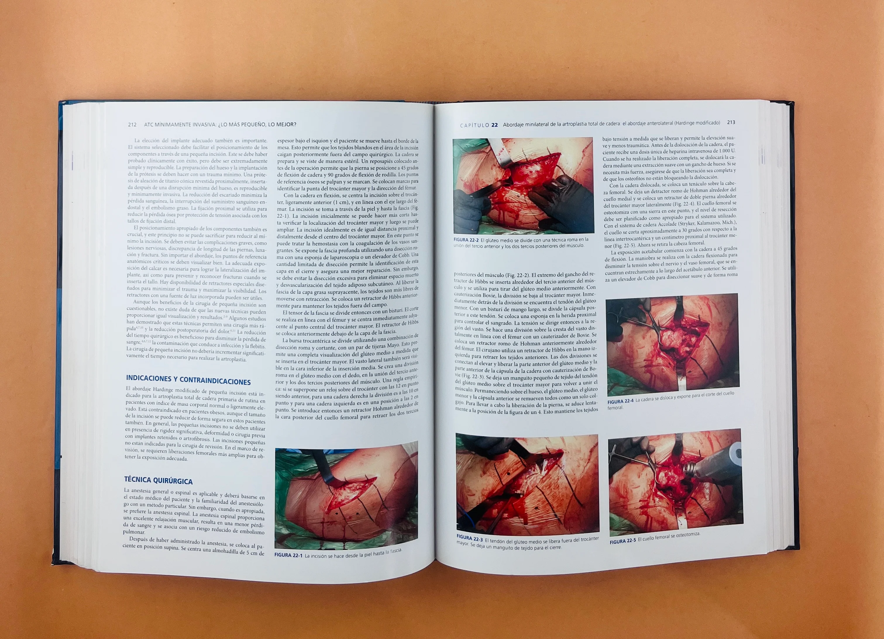 Artritis y Artroplastia Cadera - Image 4