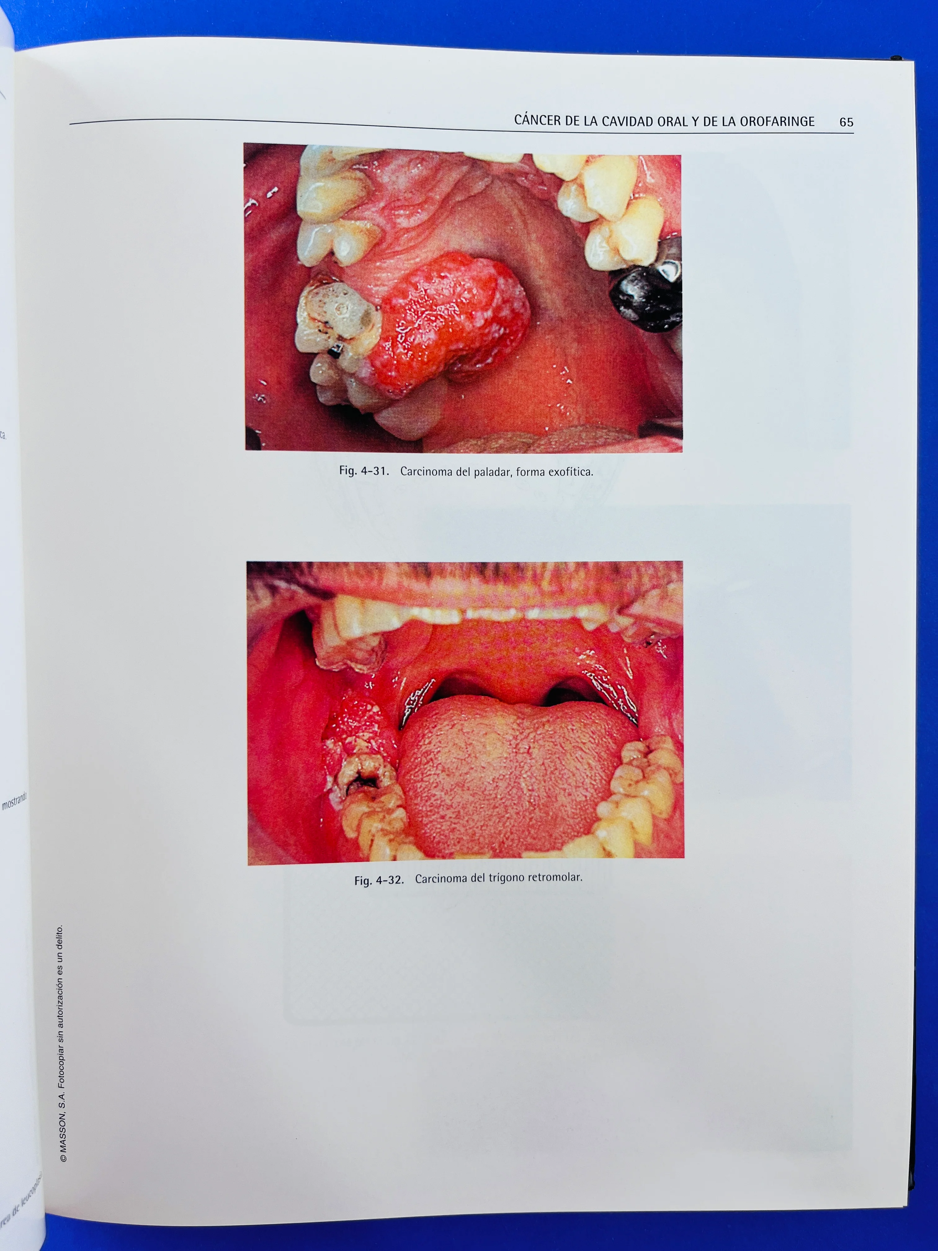 Tumores de cara, boca, cabeza y cuello atlas clínico segunda edición - Image 3